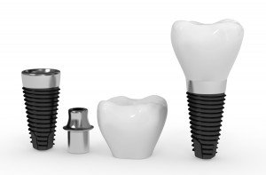 implant-dentaire-dentiste-amiens-300x197